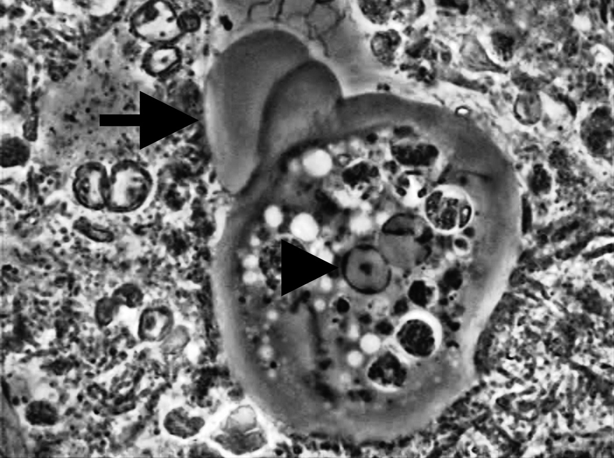 Il ruolo di Entamoeba gingivalis nella Parodontite
